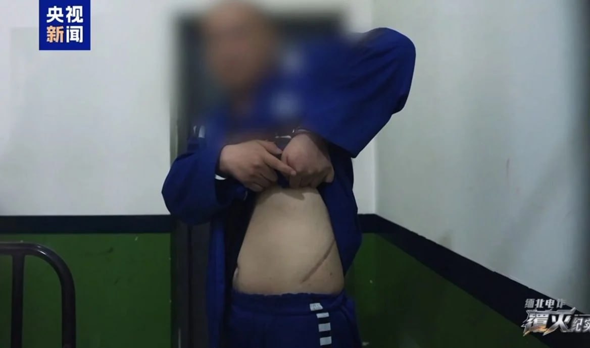 #国内新闻 卖肾抵债是真的！电诈犯现身撩开衣服 露30公分疤-manila58.com